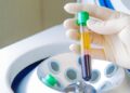 Benefits of using PRP tubes for plasma lifting and it’s advantages