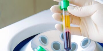 Benefits of using PRP tubes for plasma lifting and it’s advantages