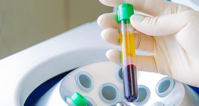 Benefits of using PRP tubes for plasma lifting and it’s advantages