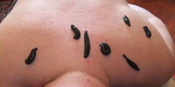 Особенности выбора пиявок для лечения и профилактики здоровья